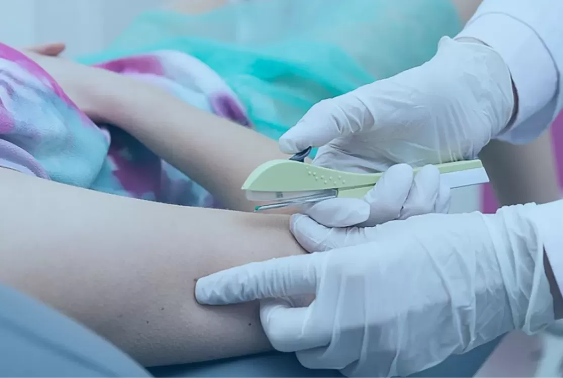 SUS disponibilizará 'implanon' gratuitamente para 4 mil mulheres de Belém